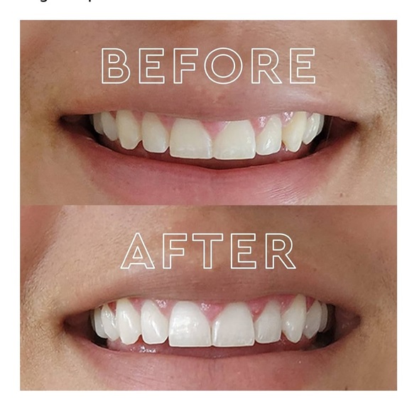 MOON Teeth Whitening Kit with LED Accelerator Light - Picture 2 of 5